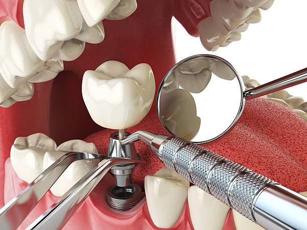Best Emergency Tooth Extraction in Sweetser, IN